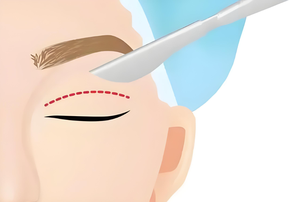 广州罗勇做双眼皮如何