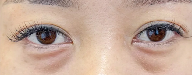 力硕才去眼袋的优势