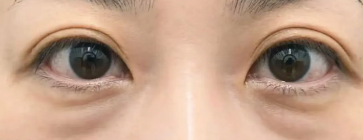 余慧云去眼袋成效