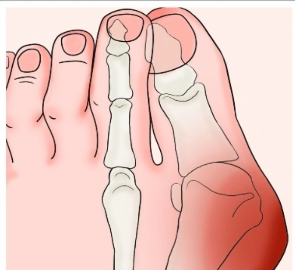 重庆大脚骨医院哪家好?2025排名情况出炉!骑士/松山微创拇外翻是微创技术,亮点比较突出