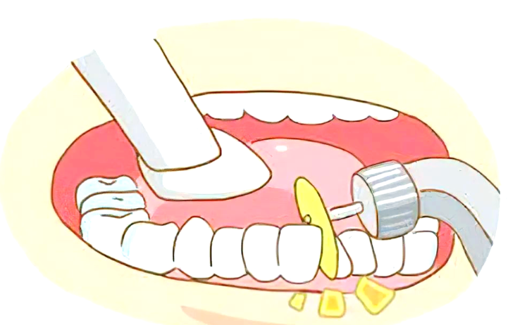 侯振杰正颌手术费用高吗?实测价格3-25万,单颌3.8-5.2万,双颌6-9.8万,你来评价高不高