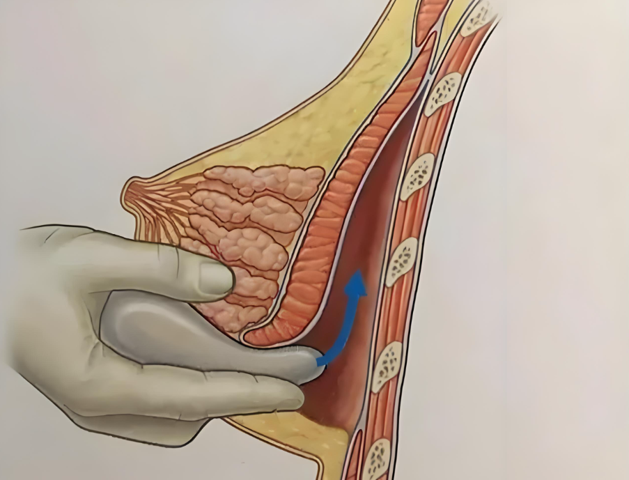 广州郝永生隆胸好不好www.aimei.com