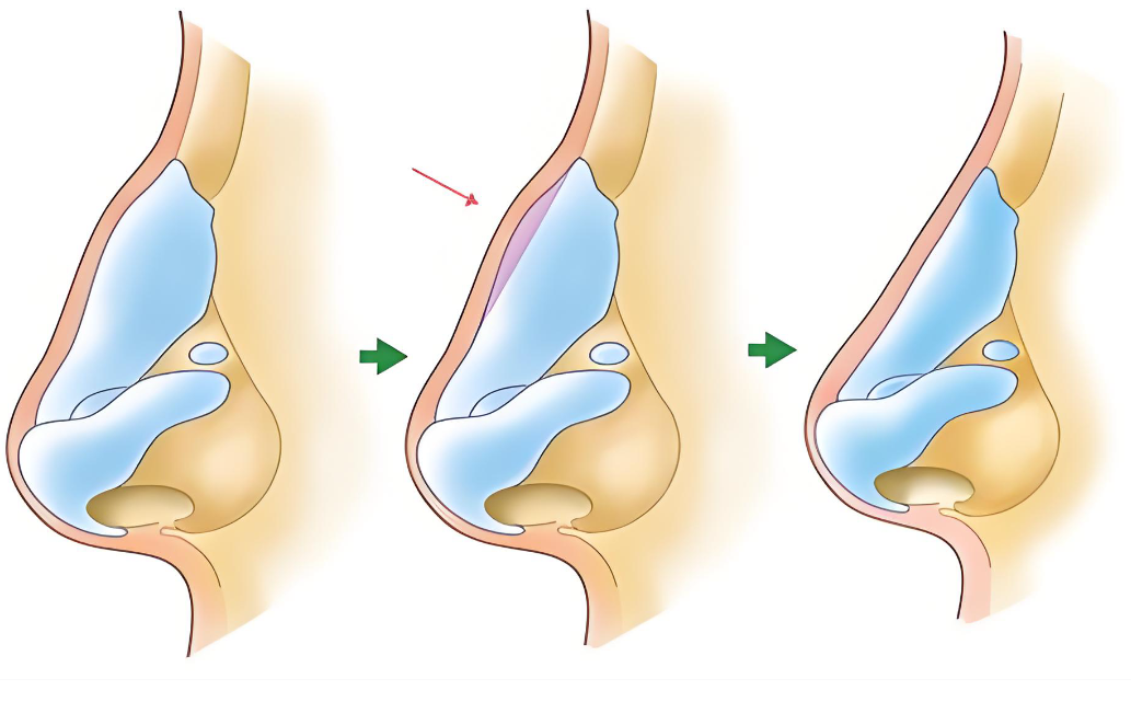 广州王宏伟隆鼻怎么样www.aimei.com