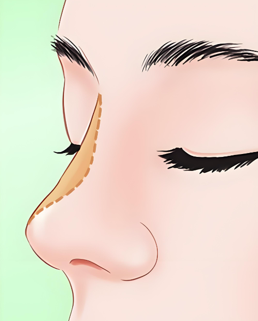 广州王宏伟整形做鼻子怎么样？老经验医生亲授：3-8万打造自然鼻型的5大秘诀