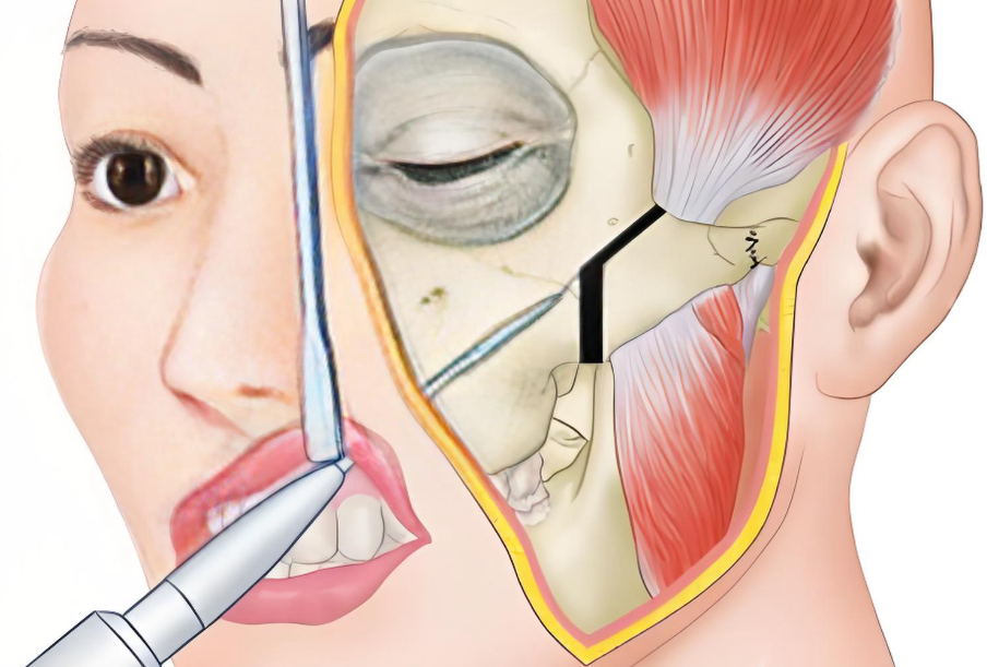 广州沈绍勇改脸型7D榫卯技术大揭秘：正规资质医生如何3天消肿？颧骨内推5mm真实实例分享