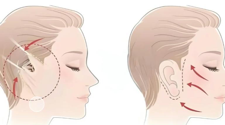 银川拉皮手术哪里做的好