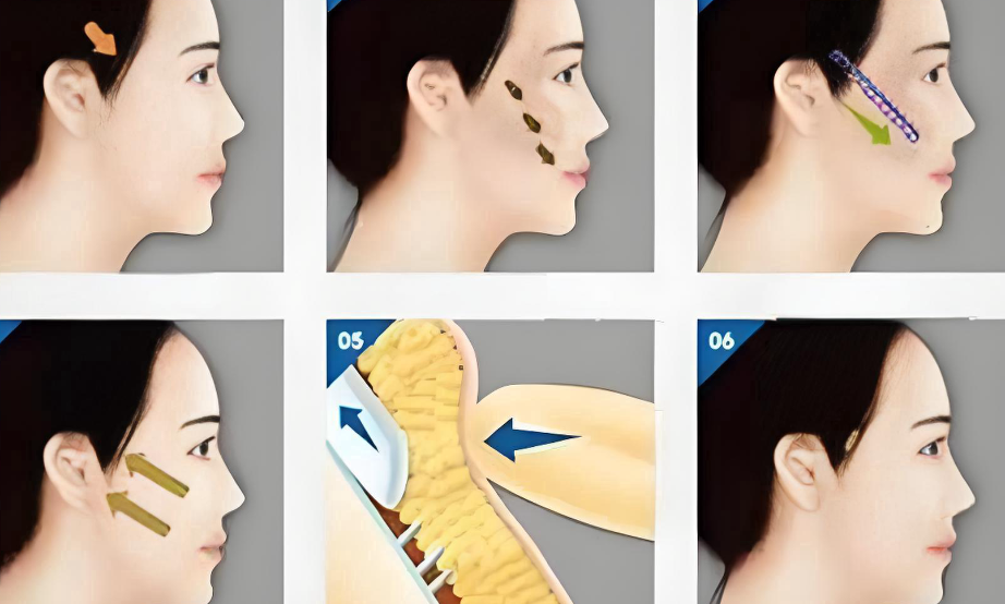 广州沈绍勇改脸型怎么样