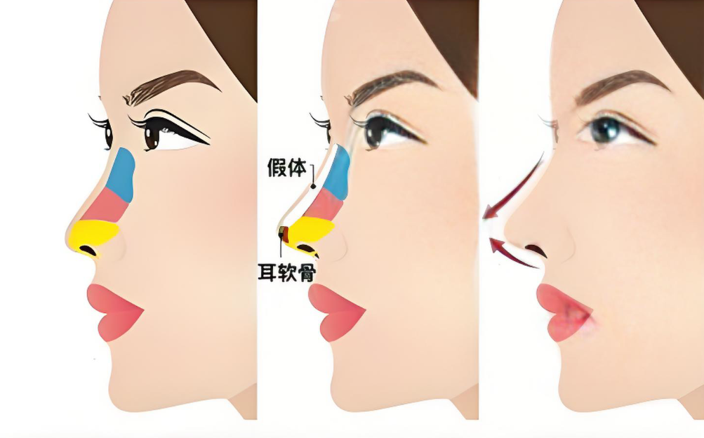 广州海峡彭栋梁做的鼻子怎么样？老经验鼻修复医生亲解：29800元起重塑自然美鼻全攻略