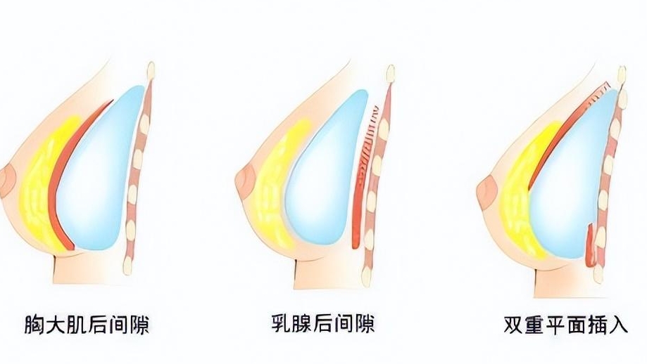 唐志荣隆胸无须避雷