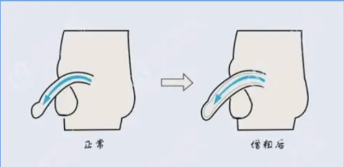 深圳男性增大增粗手术