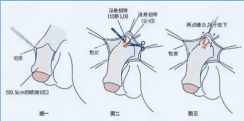 男性增大增粗手术