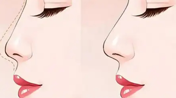 文丰轻舒鼻为什么不用带夹板