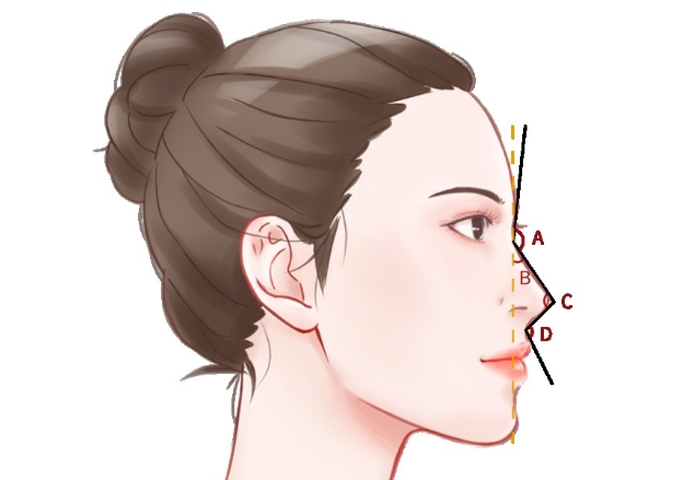 文丰轻舒鼻为什么不用带夹板