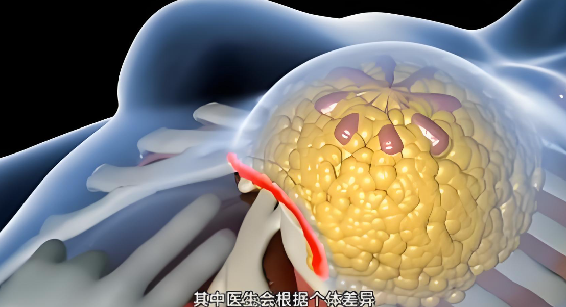 广州郝永生胸部下垂矫正术靠谱吗？内窥镜双平面技术2-3周变好，35岁宝妈亲测从B杯逆袭C杯！