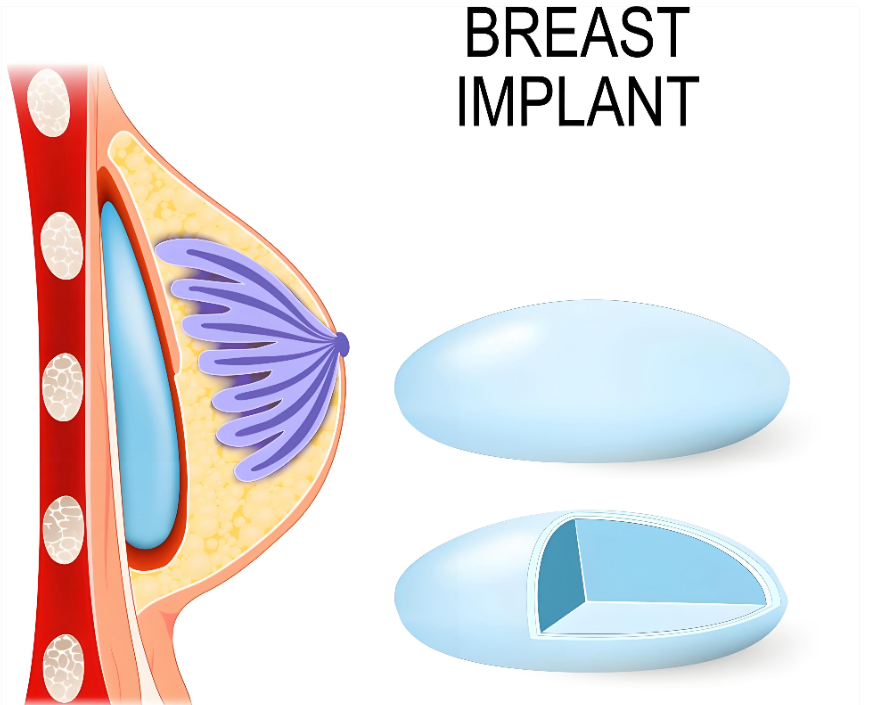广州郝永生胸部下垂矫正术靠谱吗