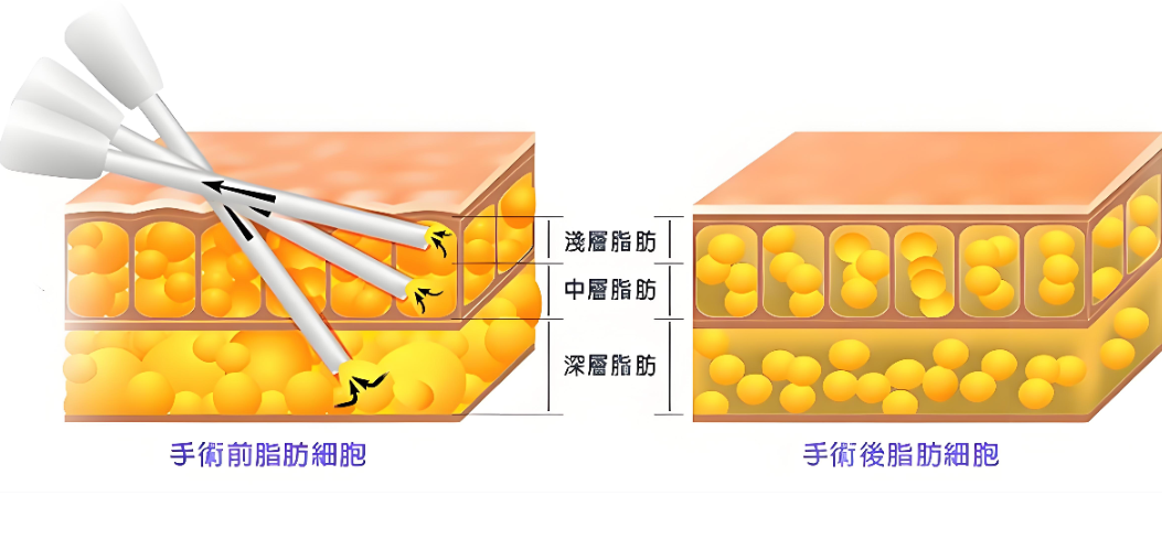 邝石峰和王世虎吸脂