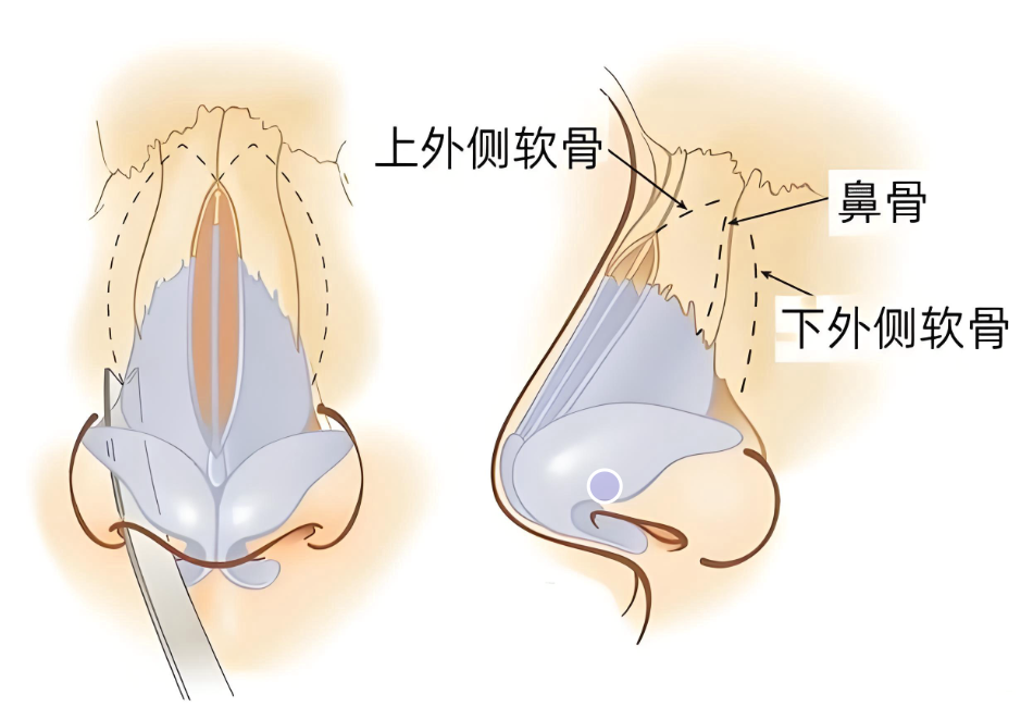 广州肖强do鼻口碑和费用：靓女亲测：自体软骨隆鼻6-12万值不值？3大避坑指南必看