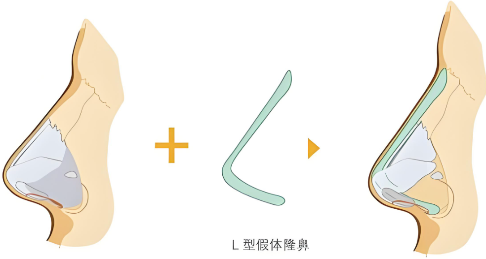 广州肖强do鼻费用