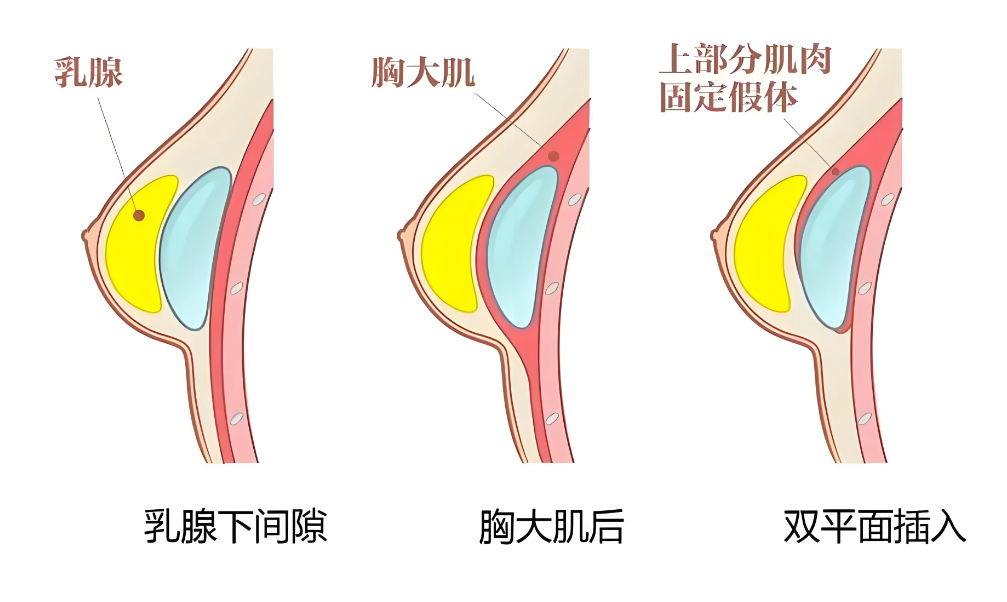 广州肖强医生在哪家医院做整形？联系他来广州丽合医疗约微创胸部整形7天变好真实体验！
