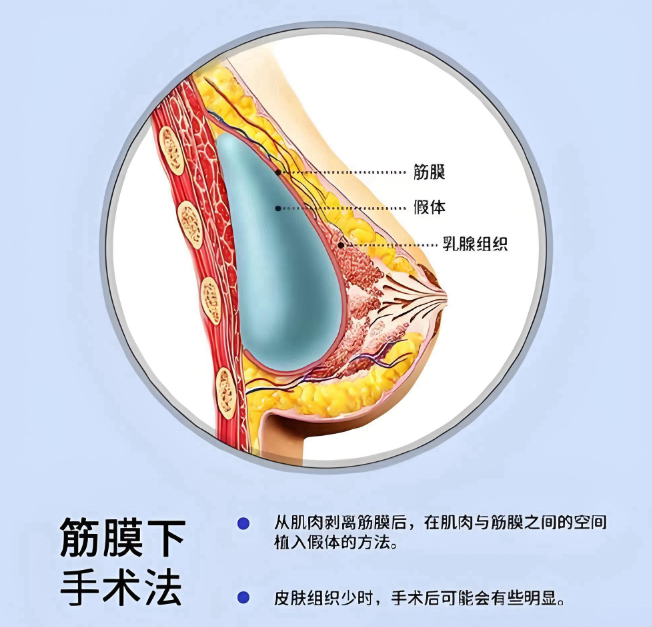 广州肖强隆胸www.aimei.com