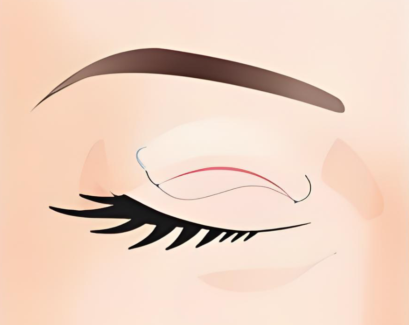 广州戚昌栋割双眼皮费用2280元起?医生亲解:肿眼泡|修复等5种情况价格差在哪?