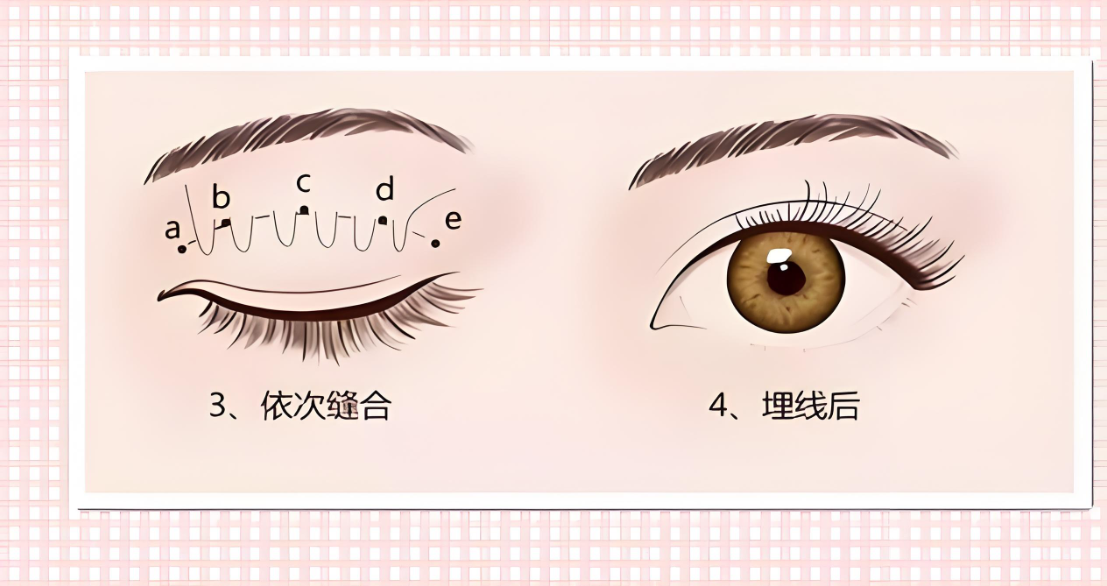 广州戚昌栋割双眼皮好不好www.aimei.com