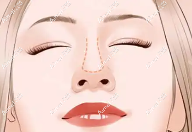 鼻部整形：自然仿生，精细雕琢