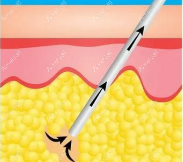 脂肪塑形：曲线，自然持久