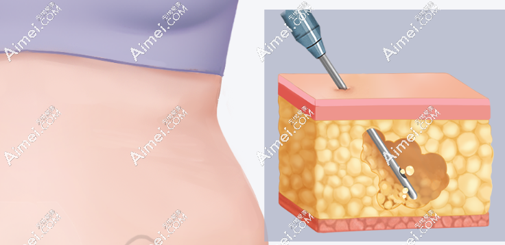南京美贝尔许佑勇医生:脂肪塑身与修复的实力派 南京美贝尔许佑勇医生:脂肪塑身与修复的实力派