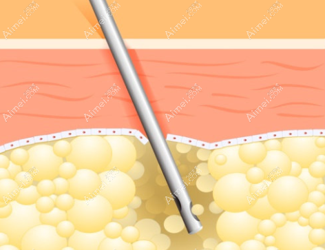 南京美贝尔许佑勇医生吸脂怎么样 南京美贝尔许佑勇医生吸脂怎么样