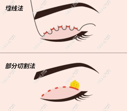 眼部整形：七度美眼，无痕灵动