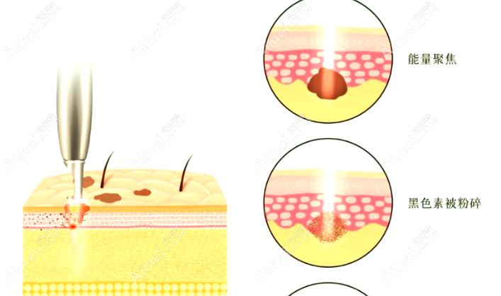 南通维多利亚李冬颖激光祛斑视图