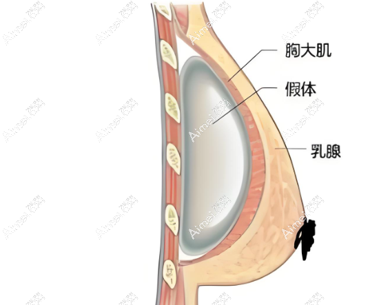 内窥镜辅助隆胸 内窥镜辅助隆胸