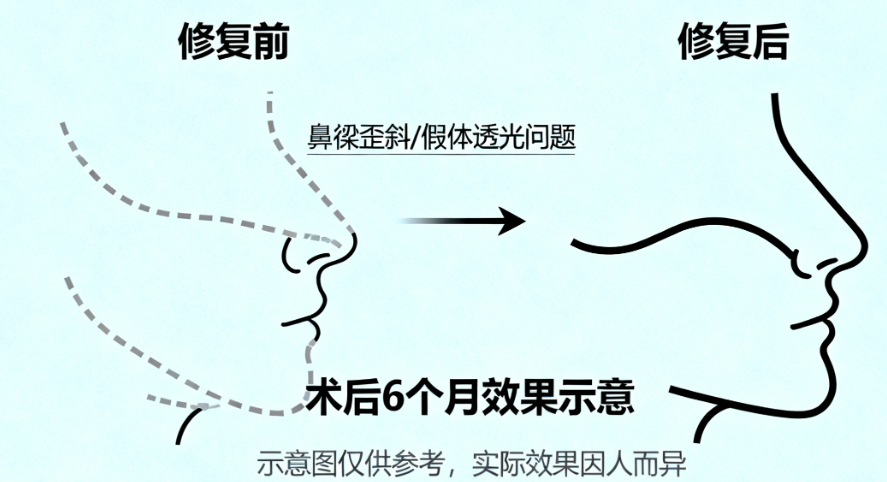 曲妙轩鼻子价格表图汇总好啦!上海鼻整形医生对比:曲妙轩vs曾高vs刘彦军附费用