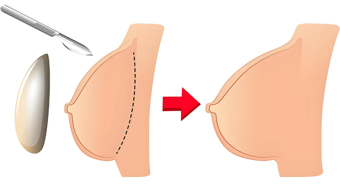 广州求美者必看：有人找过王世虎做假体隆胸吗？几十年经验医生亲授吸脂+假体联合塑形秘籍