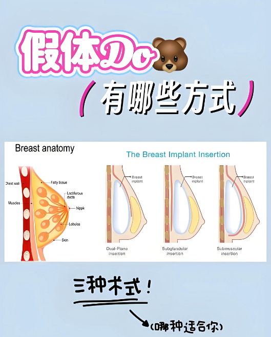 王世虎做假体隆胸