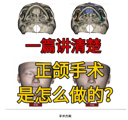 广州吴训正颌评价:0.1mm精度3D导板技术靠谱吗?华南地包天矫正真实实例大公开
