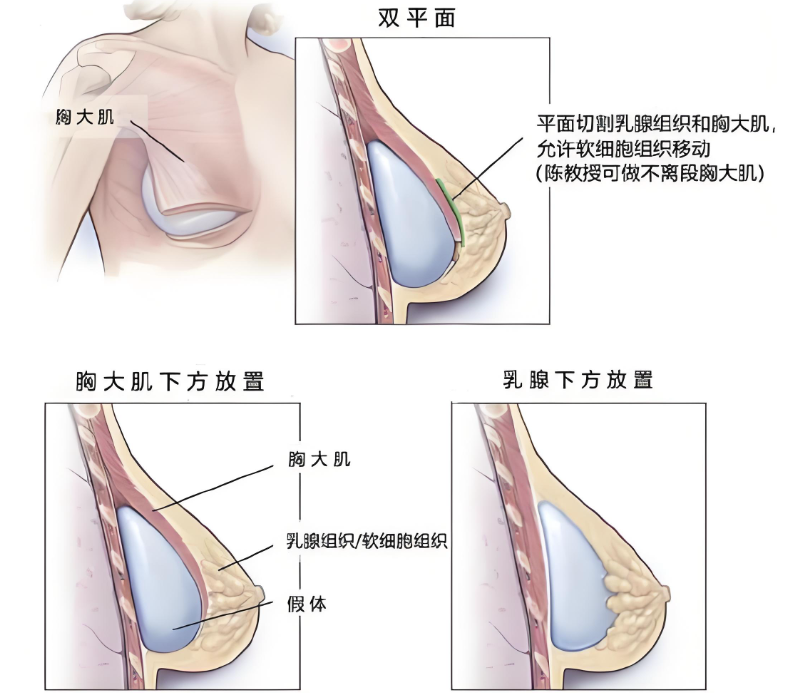 隆胸曾立和唐志荣哪个好？新测评：几十年经验DV玉兔胸技术PK，从2.5万到9.9万方案全解析