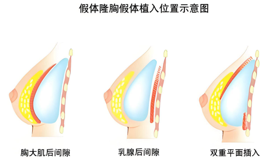曾立和唐志荣隆胸怎么样www.aimei.com