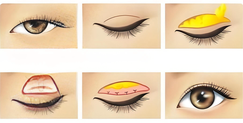 广州双眼皮修复医生如何选