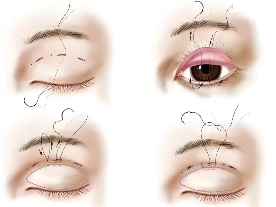 广州双眼皮修复医生名单