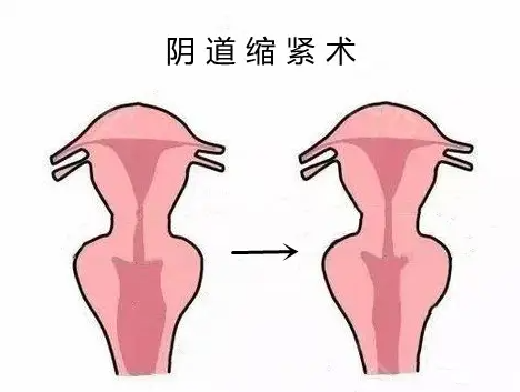 广州曙光郝卫洁医生女性私密手术价格一览表，阴道紧缩术价格39800元起无隐形消费