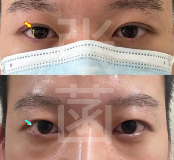 张菡双眼皮改单的常见疑问,帮你踩准“可靠线”