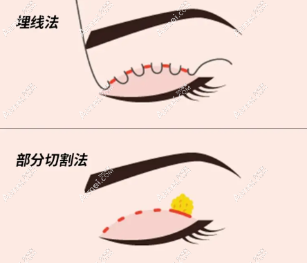 双眼皮手术 双眼皮手术