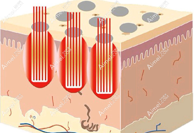 黄治平皮肤激光