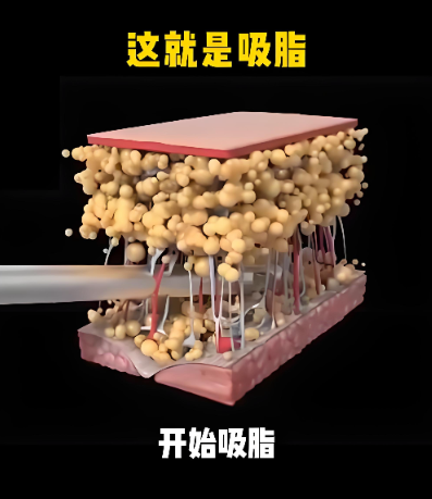 廣州郭震宇吸脂