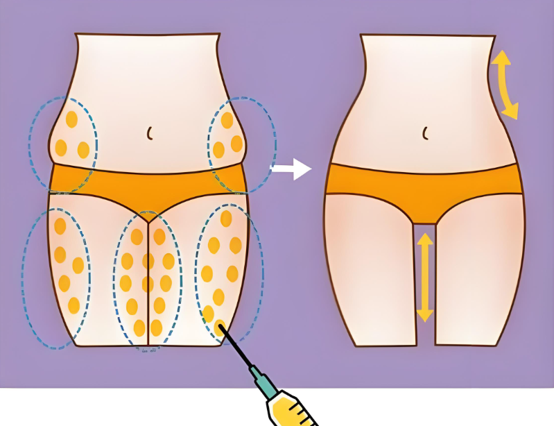 廣州郭震宇吸脂如何www.cnxhy.cn