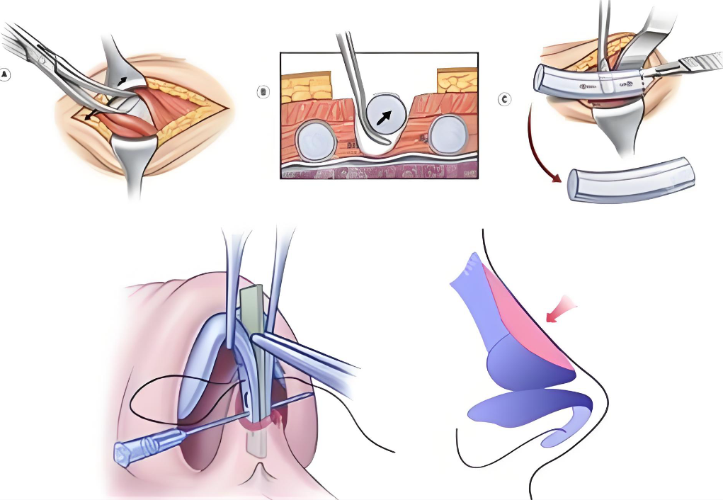 李文峰医生隆鼻失败实例