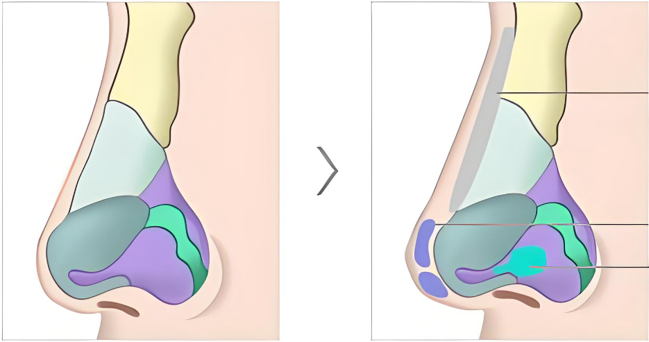 李文峰医生隆鼻www.aimei.com