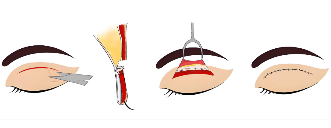 广州颜玲割双眼皮www.aimei.com